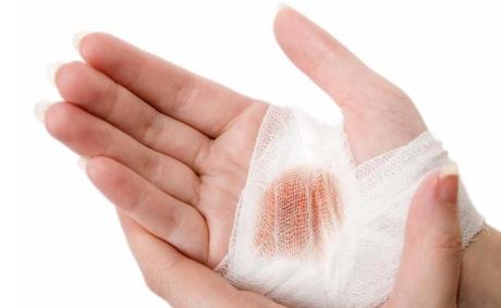 5 Natural remedies for cuts and scrapes