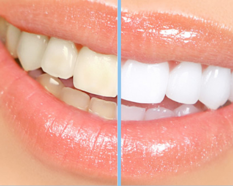 Teeth Whitening at Home