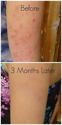 How To Heal Keratosis Pilaris With Diet