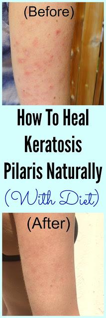 How To Heal Keratosis Pilaris With Diet