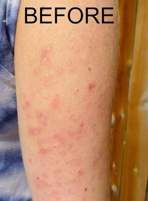 How To Heal Keratosis Pilaris With Diet