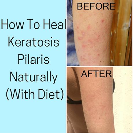 How To Heal Keratosis Pilaris With Diet