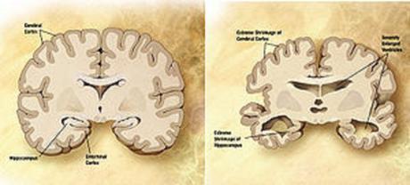 Diagram of the brain of a person with Alzheimer's Disease