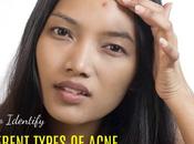 Identify Different Types Acne: Best Guide