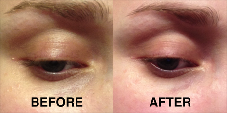 Dynamic Instant Eye Lift BEFOREafter