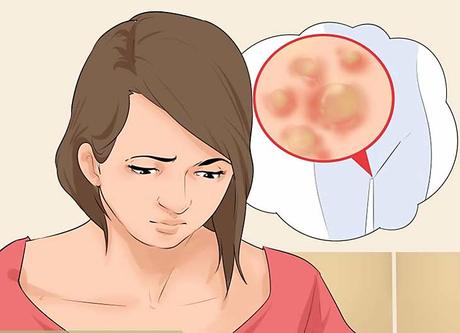 Genital Warts in Women