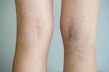 Varicose veins what is it