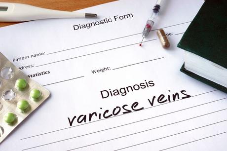 Natural and Herbs Home Remedies for Varicose Veins 