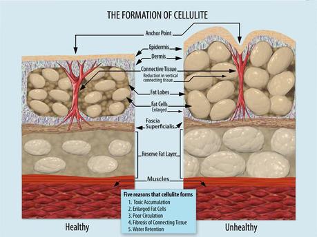 Cellulite problem - How to Get Rid of Cellulite