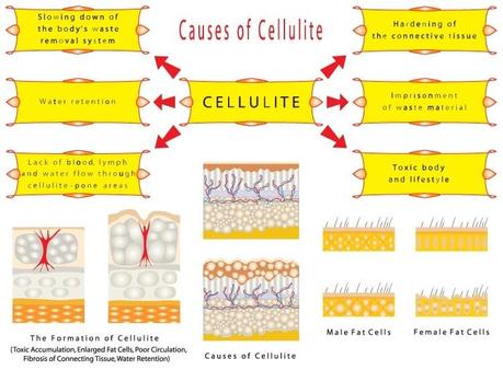 How to Get Rid of Cellulite - causes of cellulite