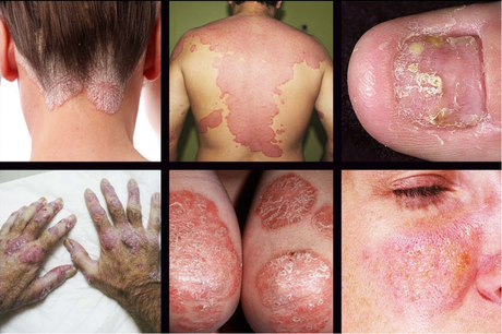 Natural Ways to Treat Psoriasis in Ayurveda