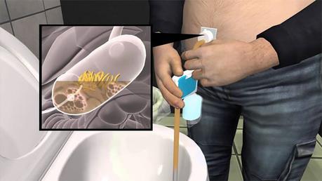 FDA Approves Bulimia Device as Treatment of Obesity