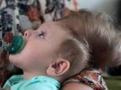 Hope’: Amazing Story Baby Born with Brain Outside Skull