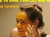 Cure Pimples Acne Using Turmeric: Best Ways