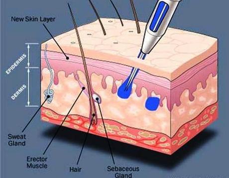 Tattoo Making Process Worst Tattoo Infection Ever