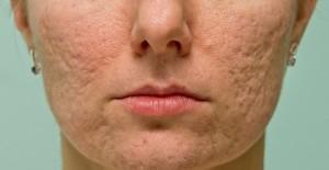 scars caused by acnes