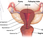 Herbal Treatment Ovarian Cysts