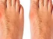Simple Powerful Natural Remedy Bunions