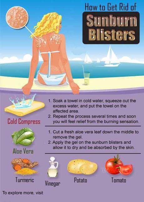 how-to-get-rid-of-sunburn-blisters