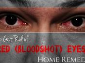 (Bloodshot) Eyes: Home Remedies