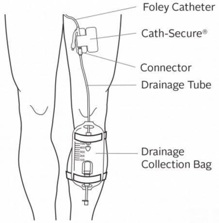 Foley Catheter