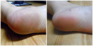 micropedi-before-and-after
