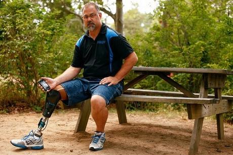 Artificial Limb Prosthetics : Overview, Procedure and Aftercare