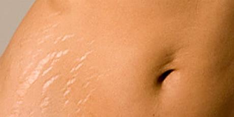 what-are-stretch-marks