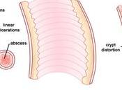 Ulcerative Colitis Treatment Management-Approach Considerations