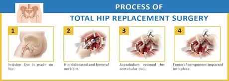 Low Cost Effective Benefits of Total Hip Replacement Surgery in India with Best hospitals & Top Hip Surgeons in India