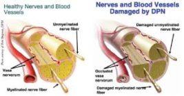 Complications of Diabetes – A Disease Affecting All Organs