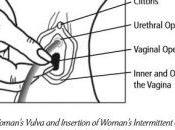 Woman’s Intermittent Catheter,