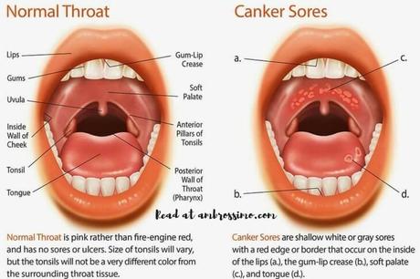 Canker sores - how to get rid of cancer sores