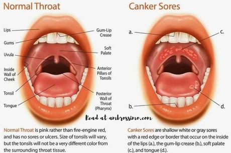 How to Get Rid Canker Sores: Cure Mouth Ulcers - Paperblog