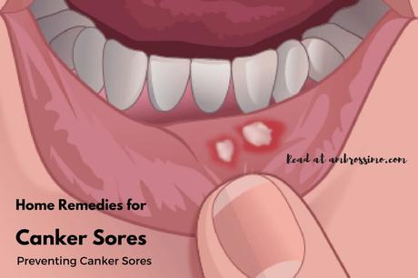 Preventing Canker Sores