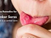 Canker Sores: Cure Mouth Ulcers