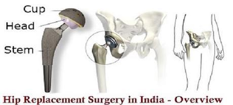 Dr. Vijay C. Bose Hip Surgeon Chennai India with Low Cost Total Hip Replacement Surgery in India