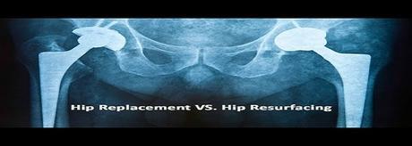 Is Hip Resurfacing a Good Option for your Arthritis? : Know About Bone-Conserving alternative to Total Hip Replacement