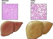 Ayurvedic Approach Fatty Liver