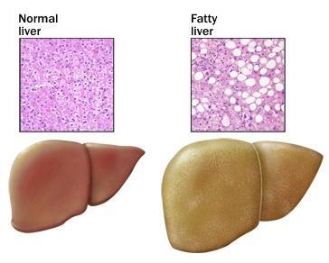 AYURVEDIC APPROACH TO FATTY LIVER