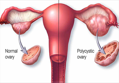 Alternative Treatment For Pcos (Polycystic Ovarian Syndrome)