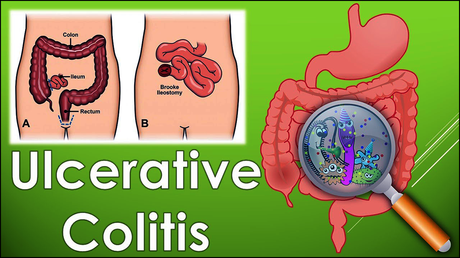 Natural Products in Treatment of Ulcerative Colitis-Herbal remedies