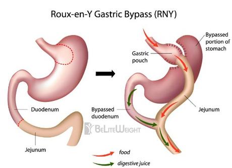 Gastric Sleeve & Bypass: Quick Facts