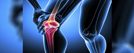 Manipal Hospital Bangalore India offers Low Cost Knee Replacements Surgery to fight from Osteoarthritis