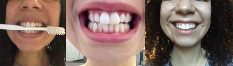 Teeth Whitening at Home with Smile Brilliant
