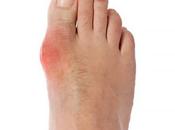 Gout Carb Ultimate Guide