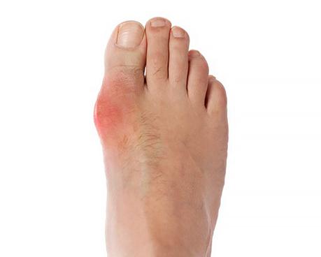Gout and Low Carb – the Ultimate Guide