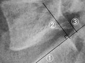 What Retrolisthesis? Back Pain