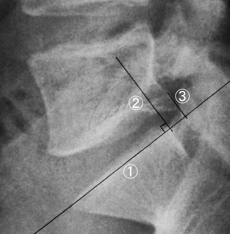 What is Retrolisthesis? - Back Pain