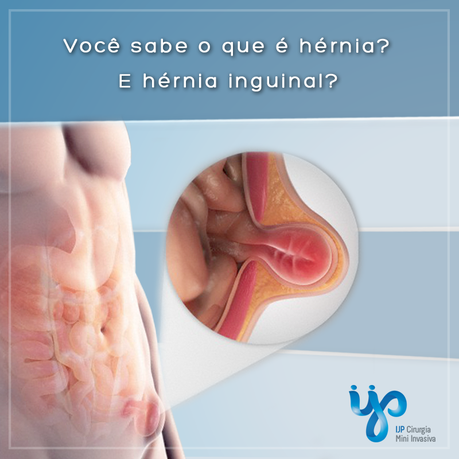 Umbilical or Paraumbilical Hernia Adults